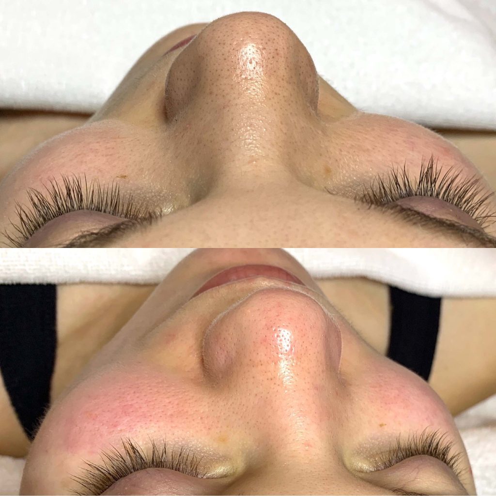 facial-taipei-sparadise-the-spa-near-taipei-101-world-trade-center-before-after-hydrafacial 白人模特兒水飛梭清粉刺療程前後對比圖