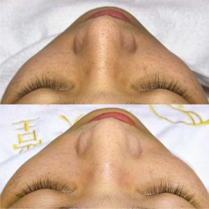 台北男生做臉推薦 male facial hydrafacial